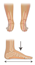 Liiallinen pronaatio