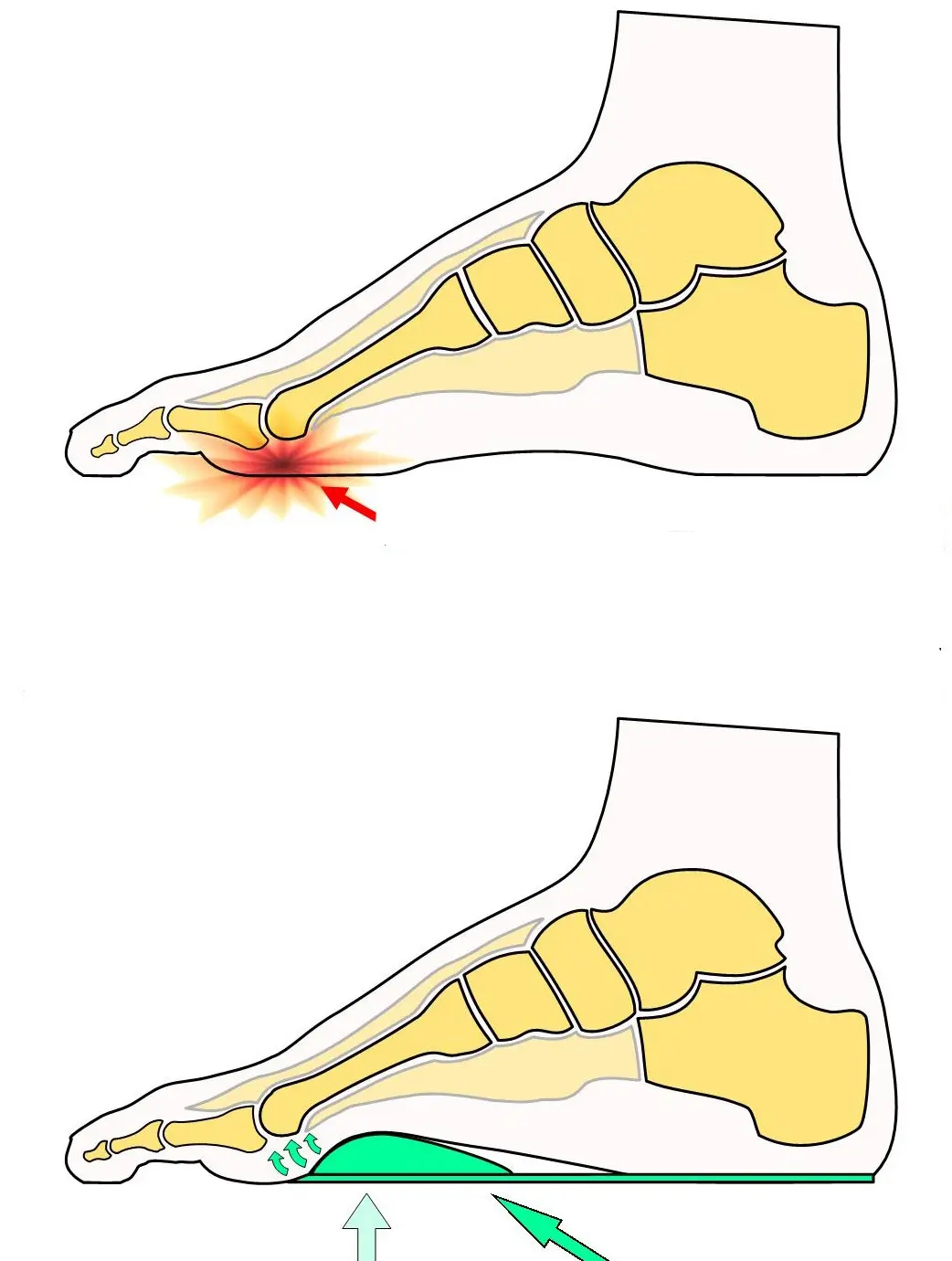 FootActive Metatarsalgia - Image 5